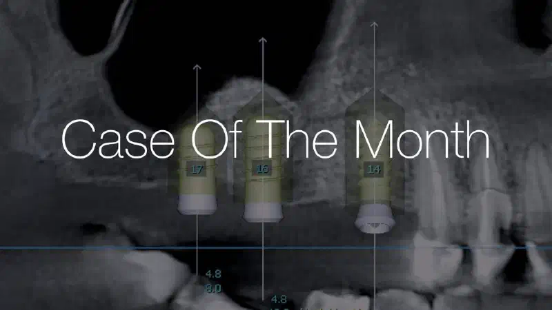 Sinus lift with additional horizontal augmentation – A 5-year follow-up