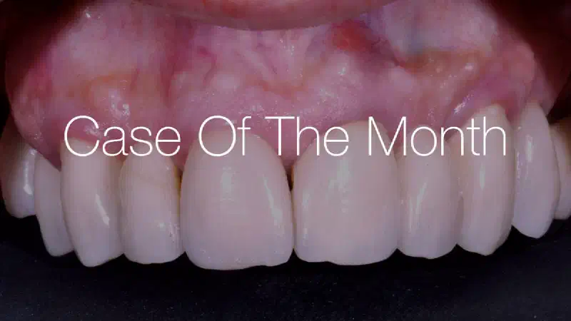 Hard and soft tissue management in immediate restoration in the aesthetic area with partial edentulism