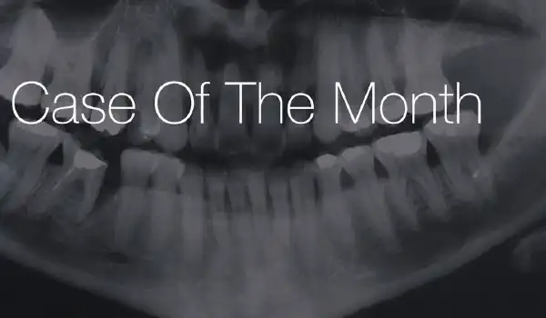 Image for case Immediate implant placement using maxresorb®