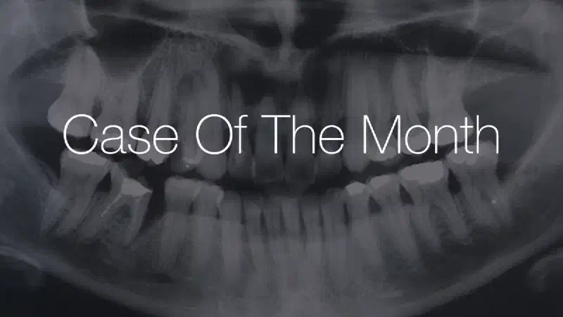 Immediate implant placement using maxresorb®