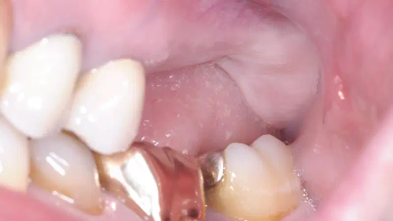 Treatment of a combined horizontal and vertical bone defect in the maxilla with maxgraft® cortico in the allogenic shell technique