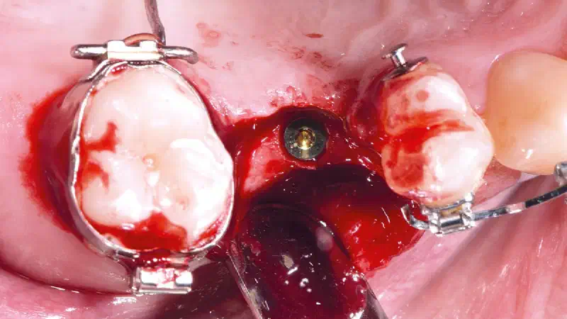 Horizontal bone augmentation using cerabone® +HyA and Jason® membrane