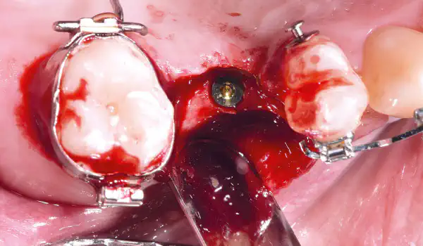 Image for case Horizontal bone augmentation using cerabone® +HyA and Jason® membrane