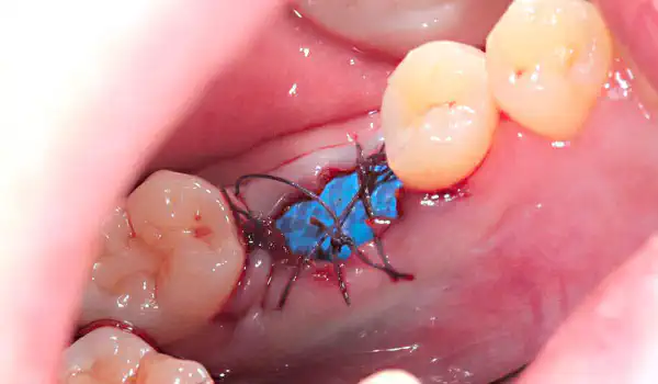 Image for case Socket preservation with permamem® and maxgraft® granules
