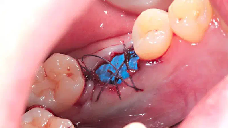 Socket preservation with permamem® and maxgraft® granules