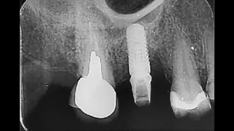 Reconstructive peri-implantitis treatment using cerabone® +HyA and mucoderm®