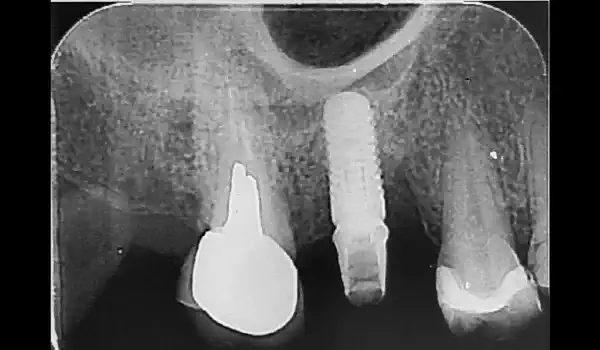 Image for case Reconstructive peri-implantitis treatment using cerabone® +HyA and mucoderm®