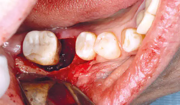 Image for case Regeneration of an intrabony defect with cerabone® +HyA