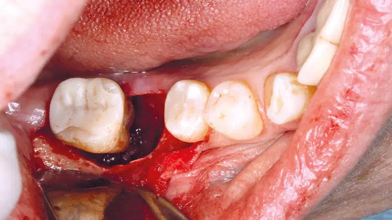 Regeneration of an intrabony defect with cerabone® +HyA