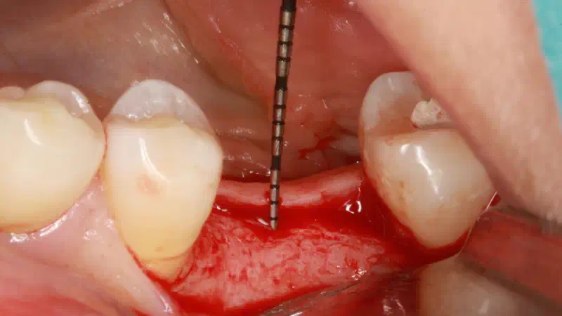 Mucosal thickening around bone level implants