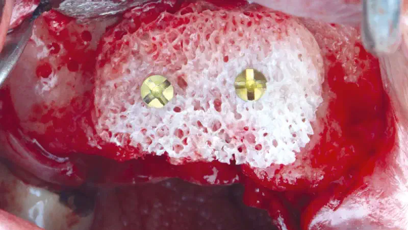 Smile rehabilitation in the anterior maxilla with maxgraft® bonebuilder