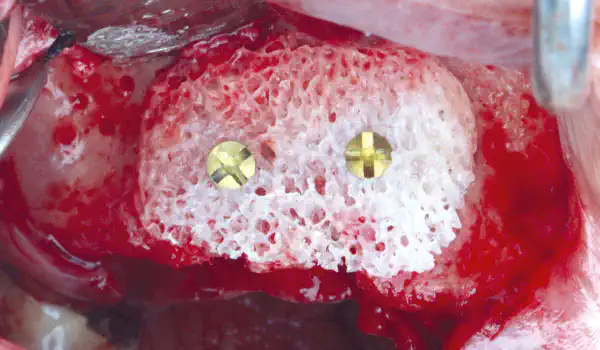 Image for case Smile rehabilitation in the anterior maxilla with maxgraft® bonebuilder