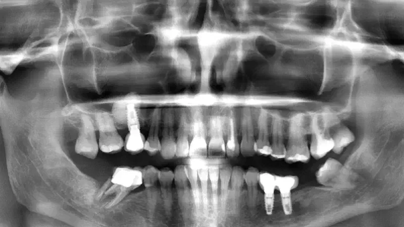 Lateral sinus floor augmentation with cerabone® with 4-year follow-up