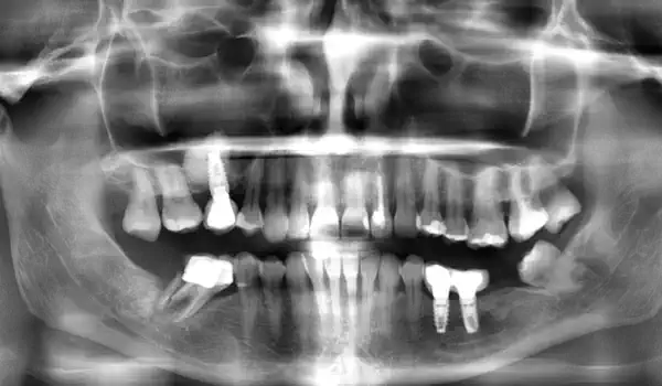 Image for case Lateral sinus floor augmentation with cerabone® with 4-year follow-up