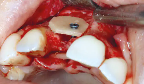 Image for case maxgraft® cortico at combined defect palatally and facially