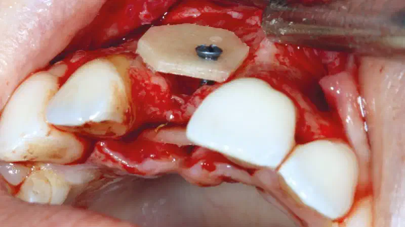 maxgraft® cortico at combined defect palatally and facially
