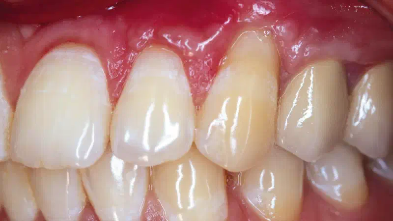 Treatment of single gingival recession with mucoderm®