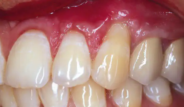 Image for case Treatment of single gingival recession with mucoderm®