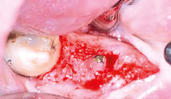 Image for case Extraction site management using cerabone® +HyA and Jason® membrane