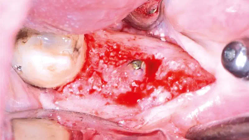 Extraction site management using cerabone® +HyA and Jason® membrane