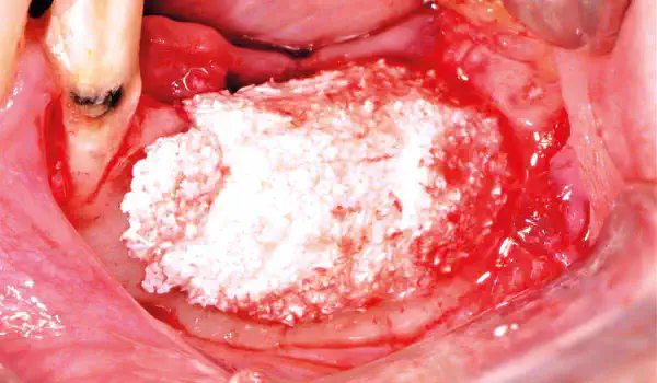 Image for case GBR at two dental implants using cerabone® +HyA and Jason® membrane