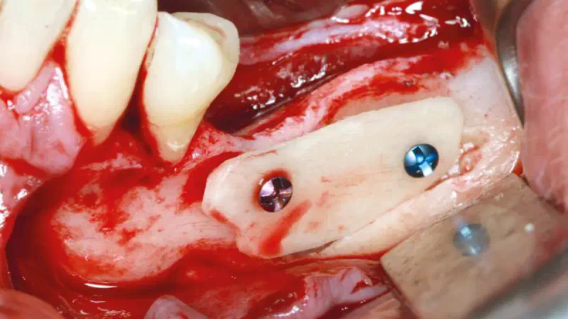 maxgraft® cortico at free-end situation in the mandible