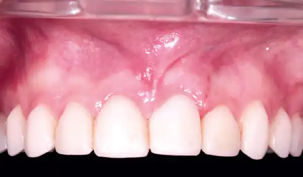 Image for case NOVAMag® Shield technique & immediate implant placement in anterior maxilla