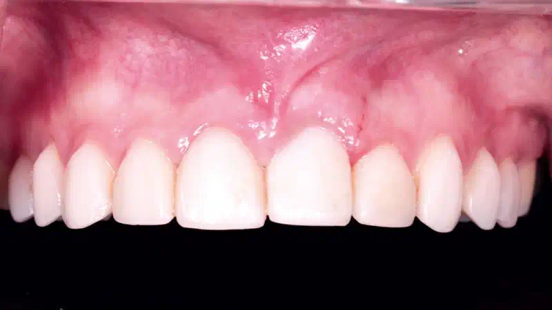 NOVAMag® Shield technique & immediate implant placement in anterior maxilla