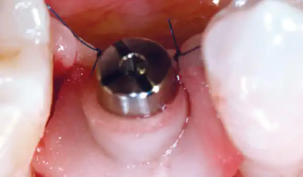 Image for case Application of mucoderm® in soft tissue management around single implants at second stage surgery