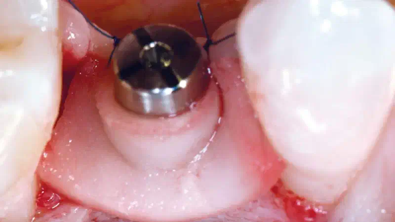 Application of mucoderm® in soft tissue management around single implants at second stage surgery