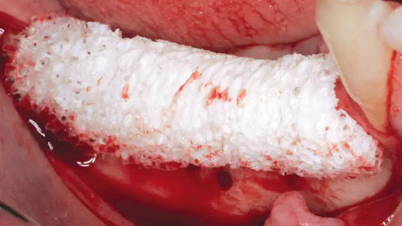 Horizontal ridge augmentation in the mandible with maxgraft® bonebuilder