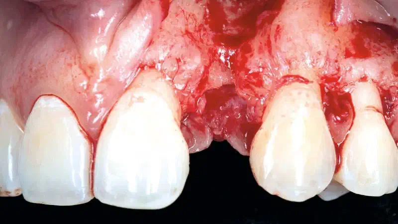 Horizontal ridge augmentation using cerabone® block, permamem® and Jason® membrane