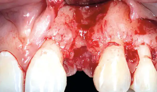 Image for case Horizontal ridge augmentation using cerabone® block, permamem® and Jason® membrane