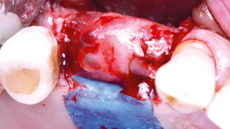Implant placement and horizontal GBR in the posterior maxilla using cerabone® and permamem®