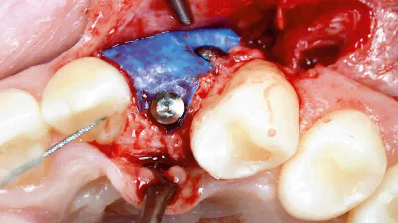 Horizontal ridge augmentation in preparation for later implant placement using cerabone® and permamem®