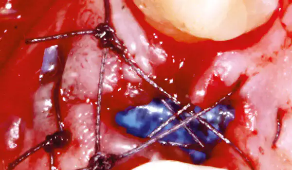 Image for case Regeneration of an extraction site using permamem®