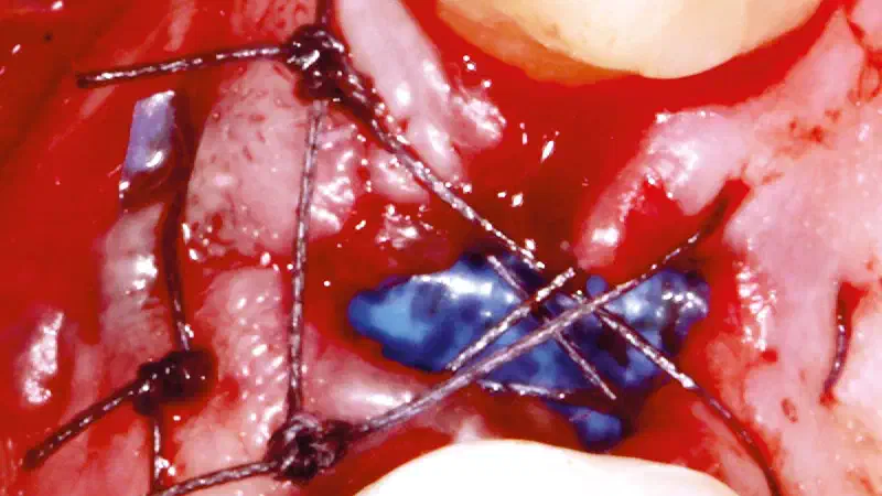 Regeneration of an extraction site using permamem®