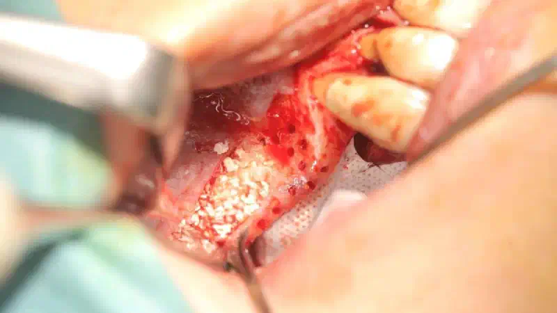 Sinus floor augmentation and horizontal/vertical GBR using cerabone®