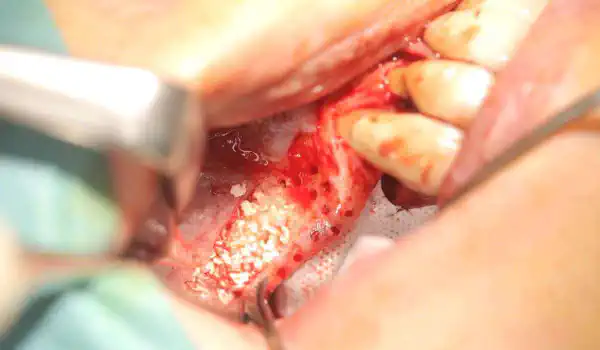 Image for case Sinus floor augmentation and horizontal/vertical GBR using cerabone®