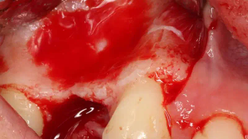 Ridge reconstruction with maxgraft® block in the posterior maxilla