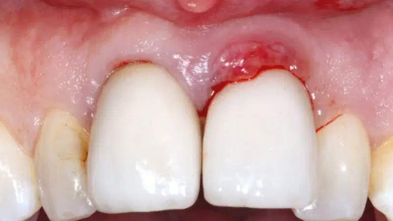GBR in the aesthetic zone with cerabone® and Jason® membrane