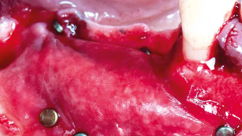 Peri-implant bone augmentation using maxgraft® and Jason® membrane