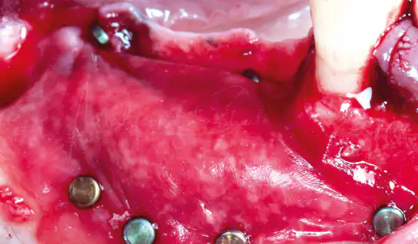 Image for case Peri-implant bone augmentation using maxgraft® and Jason® membrane