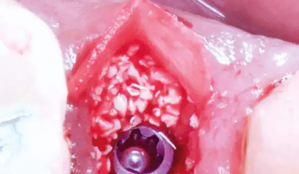 Image for case Immediate implantation combined with Ice Cream Cone-technique for buccal bone augmentation using cerabone® and Jason® membrane