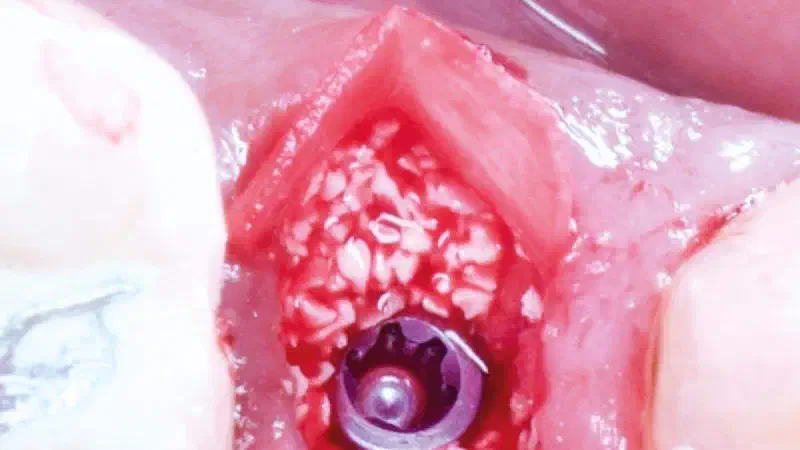 Immediate implantation combined with Ice Cream Cone-technique for buccal bone augmentation using cerabone® and Jason® membrane