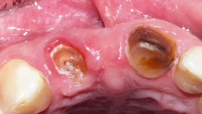 GBR with cerabone® and Jason® membrane