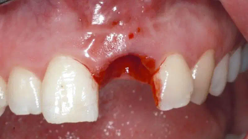 Treatment of dehiscene defect with cerabone® and Jason® membrane