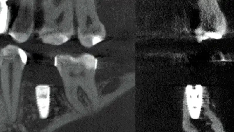 Implant placement and GBR using NOVAMag® membrane and fixation screws and cerabone® +HyA