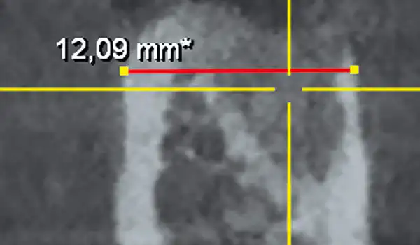 Image for case Socket Grafting with maxgraft® +HyA – Fast, Predictable Healing