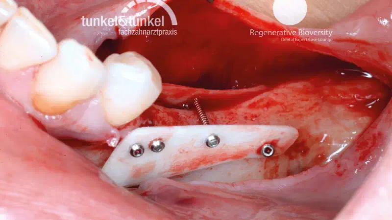 Shell Technique with augmentative relining with cerabone® and Jason® membrane (Split Mouth with maxgraft® cortico and autologous bone plates)